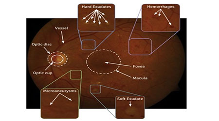 Prediction of different stages in Diabetic retinopathy from retinal fundus images using radial basis function based SVM