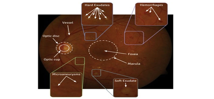 Prediction of different stages in Diabetic retinopathy from retinal fundus images using radial basis function based SVM