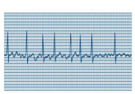 Atrial Fibrillation Discrimination for Real-Time ECG Monitoring Based On QT Interval Variation