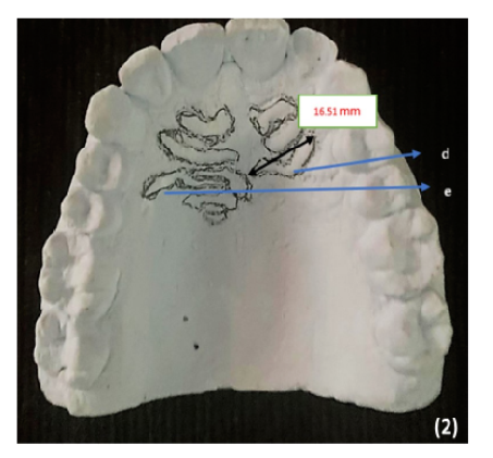 Application of Calcorrugoscopy for Assessing Variations in Palatal Rugae Pattern among the Native Population of Riyadh Province in Saudi Arabia
