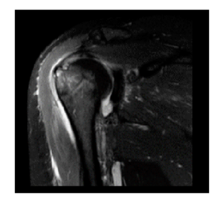 Evaluation of the Efficiency and Effectiveness of MRI in the Diagnosis of Chronic Shoulder Pain