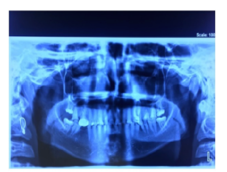 Prosthodontic Management of Dentinogenesis Imperfecta - A Case Report