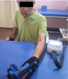 Rehabilitation of Left-Sided Hemiparesis Post-MCA Infarction Using Faradic Electrical Stimulation and Robotic Hand Rehabilitation: A Case Report