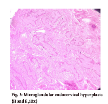 Histopathological Study of Non Neoplastic Lesions of the Uterine Cervix - A Prospective Study