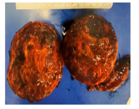 Pediatric Solid Pseudopapillary Tumor of the Pancreas: Case Series and Literature Review