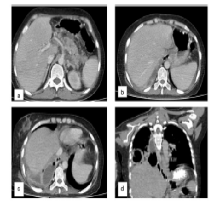 Imaging of Rare Complications of Pancreatitis – A Case Series