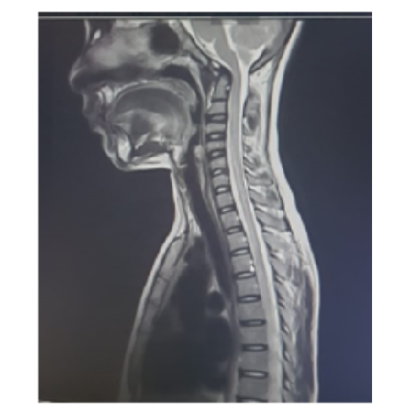 A Rare Case Report of Atypical Presentation of Acute Disseminated Encephalomyelitis (ADEM)