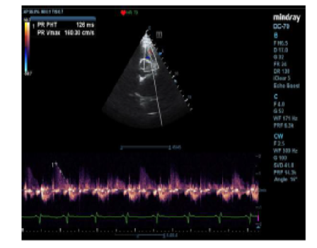 Evaluation of Echocardiographic Parameters in Patients of Acute Right Ventricular Myocardial Infarction and it’s Association with In-Hospital Outcome