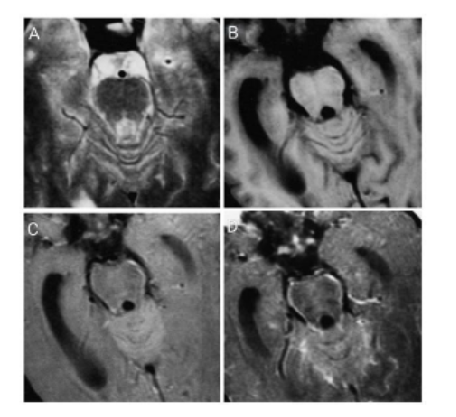 Unveiling Hidden Pathology: A Review of Magnetization Transfer Imaging in the Detection and Characterization of CNS Infections