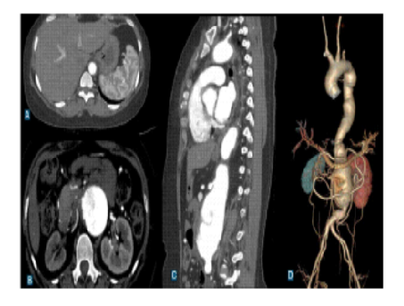 Atypical Radiological Presentation of Takayasu Arteritis: A Case Series