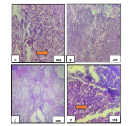 Kruckenberg Tumour Secondary to Occult Colonic Mucinous Adenocarcinoma: A Diagnostic Challenge in A Young Female