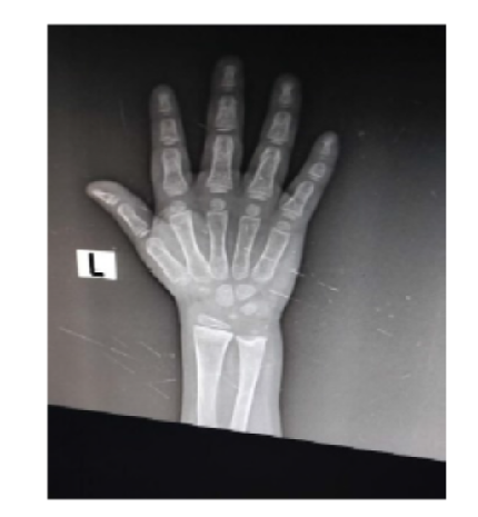 Laron Syndrome (LS) – A Rare Case Report