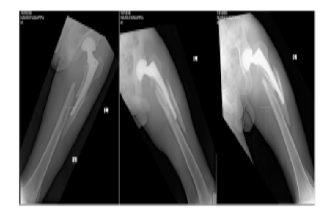 Revision Total Hip Arthroplasty + Stabilisation with Stainless Steel Wires for Periprosthetic Fractures
