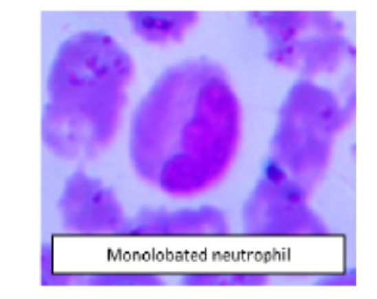 Peripheral Blood Smear Cell Morphology in COVID-19 Cases – A Cross Sectional Study
