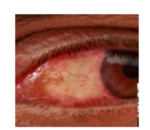 Insights into Ocular Surface Squamous Neoplasia – A Case Study in Diagnosis and Management