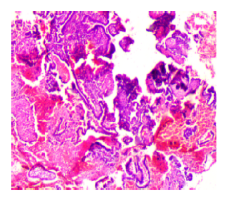 The Histomorphological Examination of Endometrium in Cases of Abnormal Uterine Bleeding