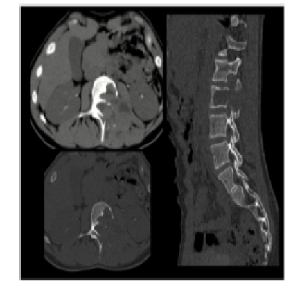Aneurysmal Bone Cyst of Vertebrae: A Rare Case Presentation