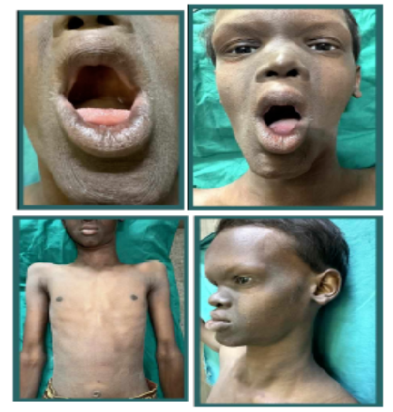 A Rare Case of Hypohidrotic Ectodermal Dysplasia