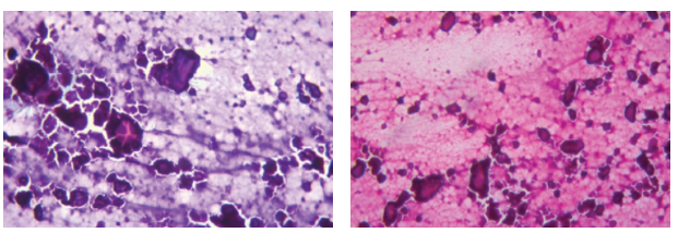 Idiopathic Calcinosis Cutis Masquerading as Malignancy - The Mystery of Two Cases Revealed on Cytology