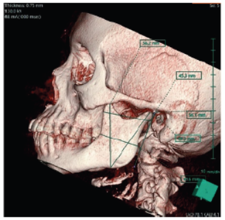 Computed Tomographic Evaluation of Mandibular Ramus for Gender Identification
