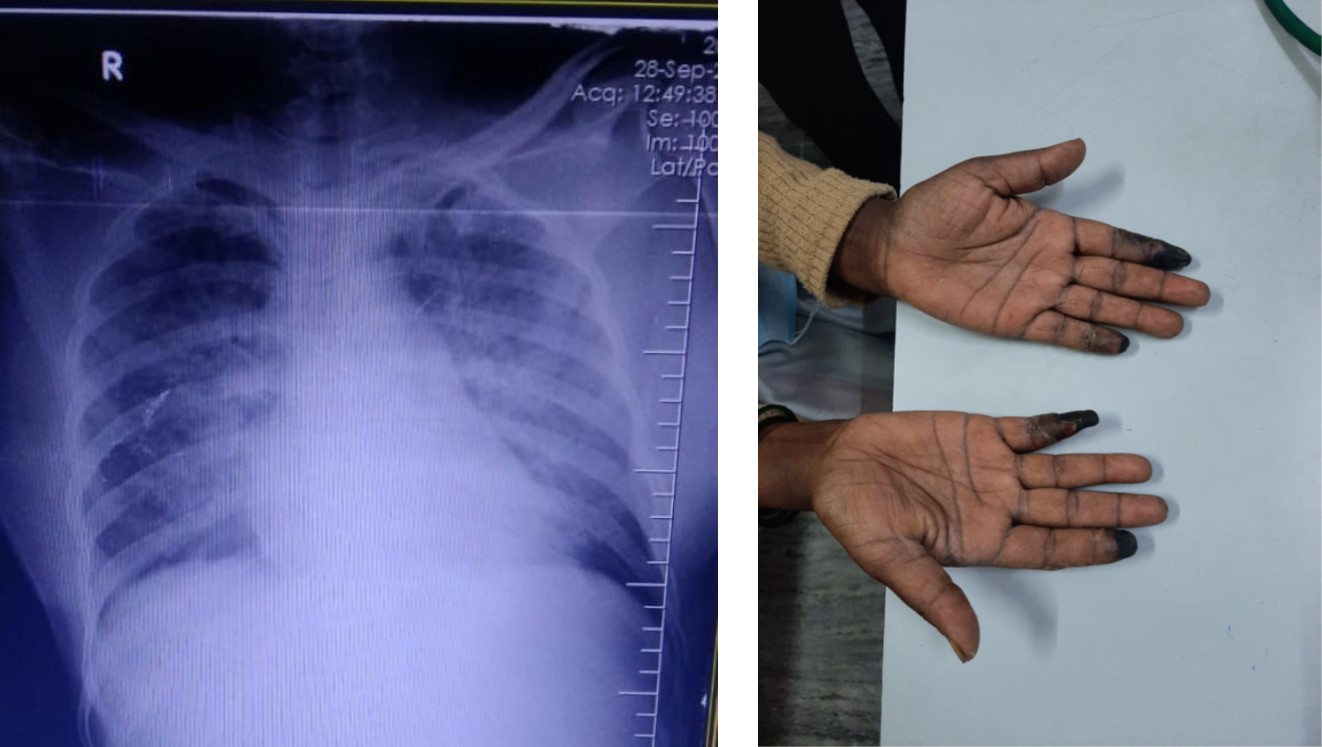 Symmetric Peripheral Gangrene Secondary to Sepsis