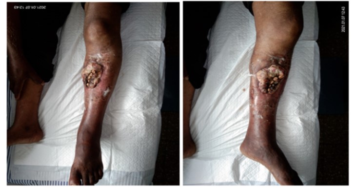 Adenosquamous Cell Carcinoma Secondary to Chronic Osteomyelitis of the Tibia - Rare Case Report