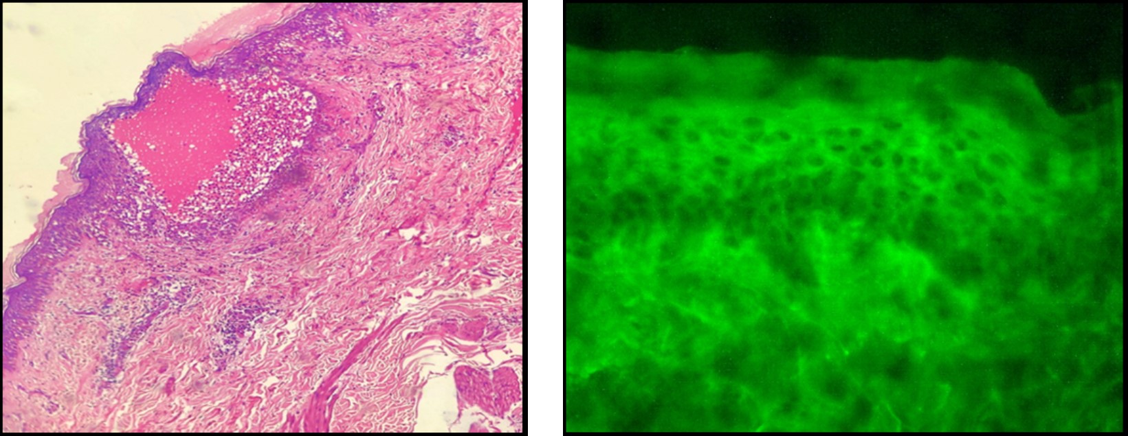 Direct Immunofluorescence in Cutaneous Vesiculobullous Lesions: A Cross-sectional Study in a Tertiary Care Center