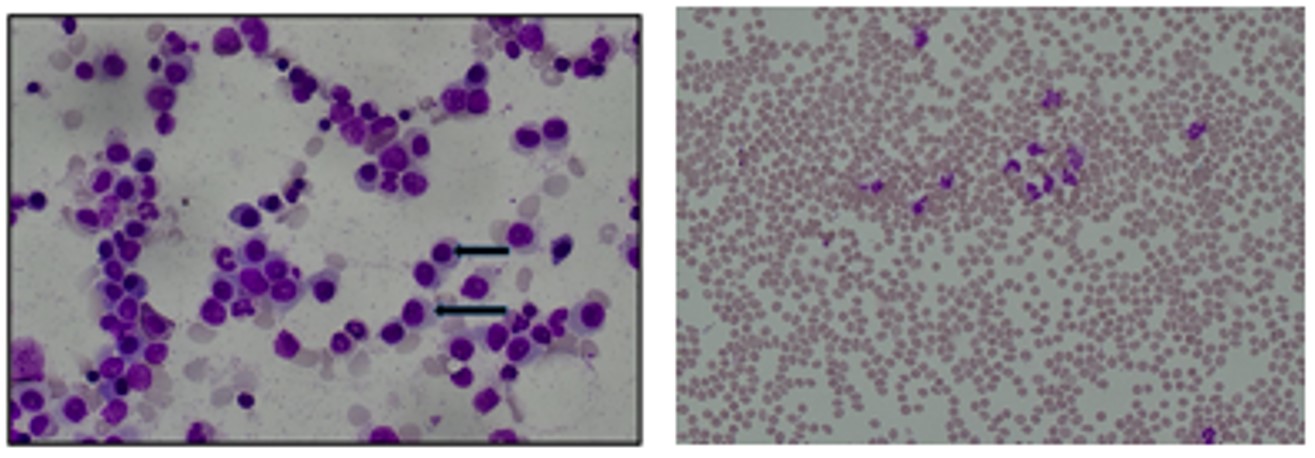 Non Secretory Myeloma with Acute Renal Failure- A Case Report