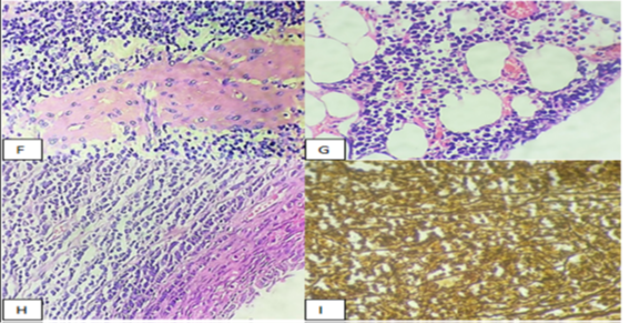 Rare ovarian neoplasm: Primary precursor B-cell Lymphoblastic Lymphoma involving bilateral ovaries