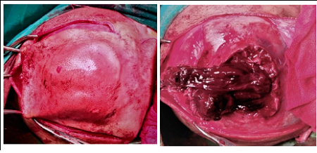 Congenital cavernous hemangioma of the skull - A rare case in infants