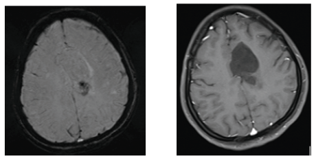 Intracranial Epidermoid Cyst: A Rare Case Series of 3 Patients