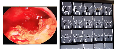 Unilateral Sphenoidal Mucocele with Nasal Polyposis - A Typical Presentation