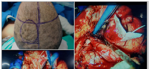 Neuro-Anesthetic Management of Craniotomy-Surgery in Removal Tumor of Left Parasagittal Meningioma Patients: A Case Report