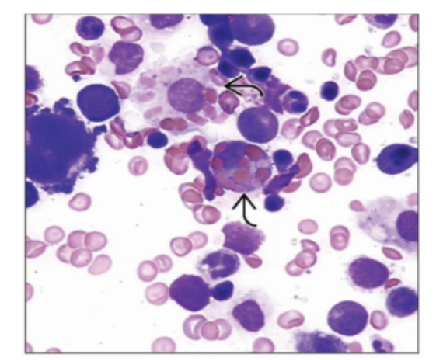 Hemophagocytic Lymphohistiocytosis: A Rare Case