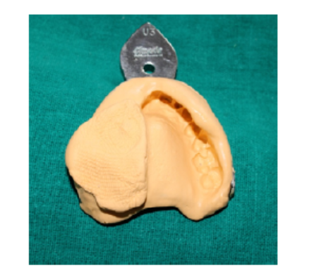 Rehabilitation of a Patient with Acquired Maxillary Defect using CPD with Extra-Coronal Attachment - A Cost-Effective and Time-Saving Procedure