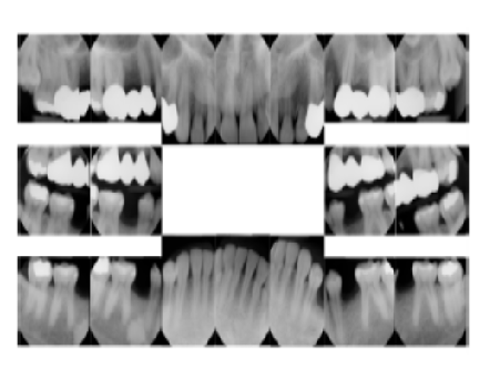 Lipoid Proteinosis Beyond the Skin: Unmasking its Oral Presentation