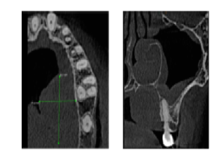 Epithelial Myoepithelial Carcinoma of Palate: Consider, Contemplate and Confirm