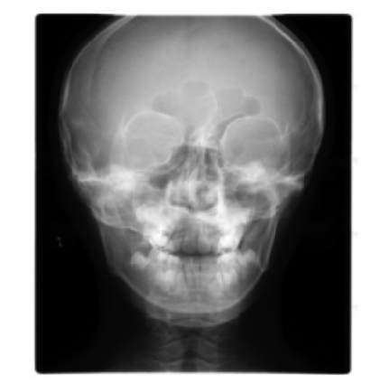 Conservative Management of Temporomandibular Disorders in Children
