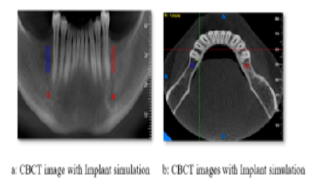 In Vivo Evaluation of Crestal Bone Loss in Placement of a Screw Vs Cement Retained Single-Tooth Posterior Dental Implant Prosthesis
