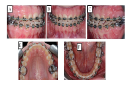An Integrated Concept for Orthodontic-Orthognathic Treatment – Management of Class III Dysgnathia with Laterognathia