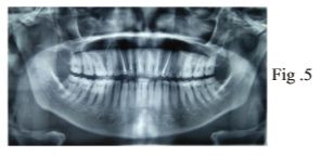 Amelogenesis imperfecta: a case report