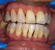 Granulomatosis with polyangiitis(wegener’s granulomatosis); an ...