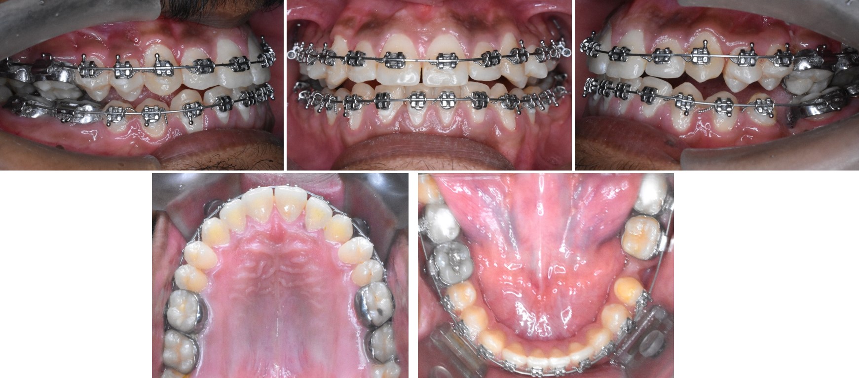 Rapid correction of constricted maxillary arch in a class III patient ...