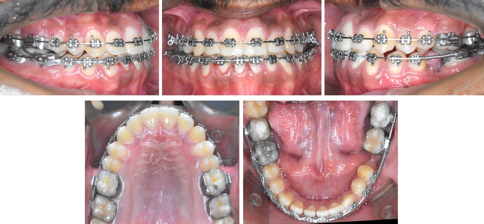 Rapid correction of constricted maxillary arch in a class III patient ...