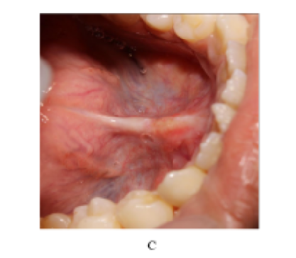 Combined Vestibuloplasty and Frenectomy for Functional and Esthetic Rehabilitation: A Case Report