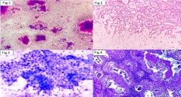 The Milan System for Reporting Salivary Gland Cytopathology (MSRSGC) for Assessment of Diagnostic Accuracy of Fine Needle Aspiration Cytology and Malignancy Risk Stratification in Salivary Gland Lesions