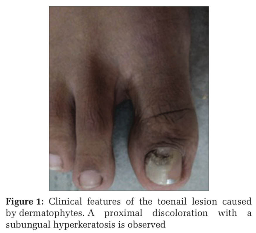 Pigmented lesion on nail bed: Pseudo-Hutchinson sign | Cleveland Clinic  Journal of Medicine