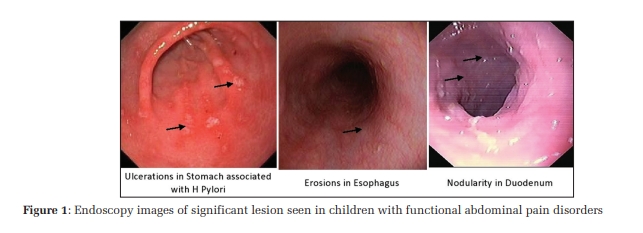 Role of Gastrointestinal Endoscopy and Biopsy in Children with Functional Abdominal Pain Disorders