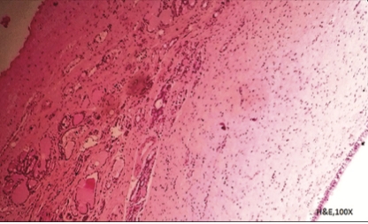 A Rare Case of Epidermal Inclusion Cyst of Thyroid Gland