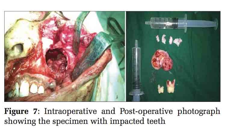 Dentigerous Cyst: An Unusual Presentation with Angiomatous Changes